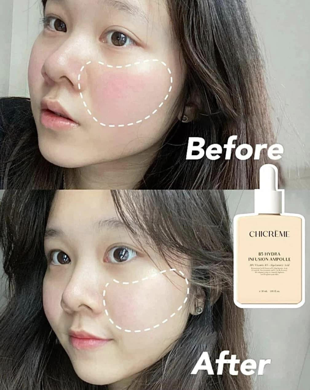 CHICREME B5 HYDRA INFUSION AMPOULE 30ML