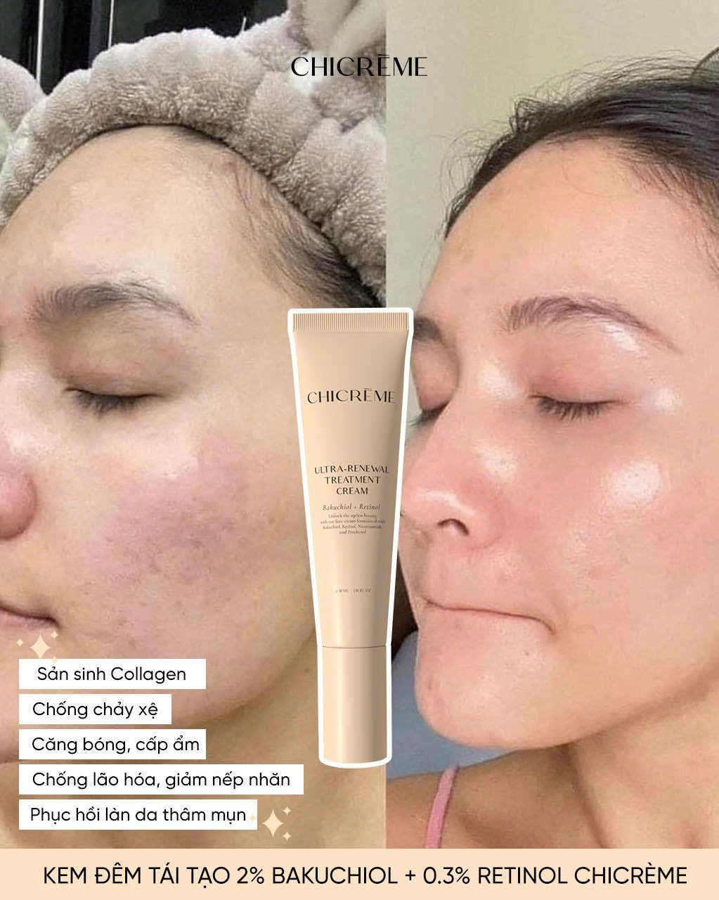 CHICREME B5 HYDRA INFUSION AMPOULE 30ML & ULTRA RENEWAL TREATMENT CREAM 30ML BUNDLE